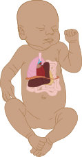 Congenital Diaphragmatic Hernia